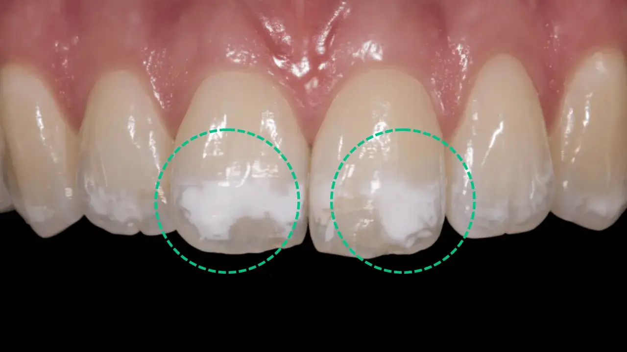 Dientes frontales con manchas blancas y aspecto poroso, resaltadas con c&iacute;rculos verdes.