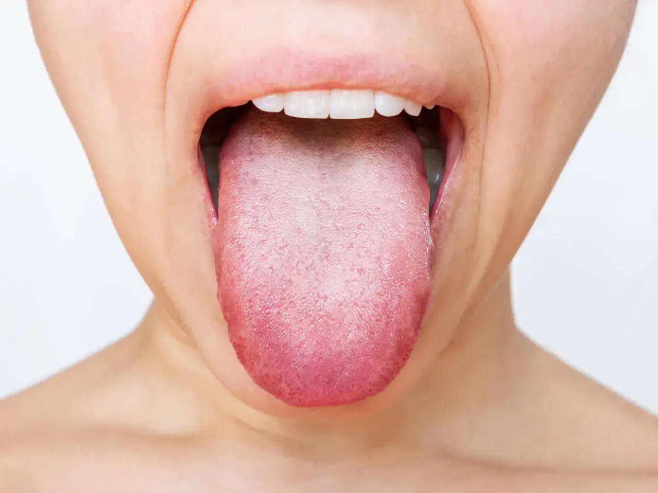 Boca abierta mostrando lengua blanca y llagas.