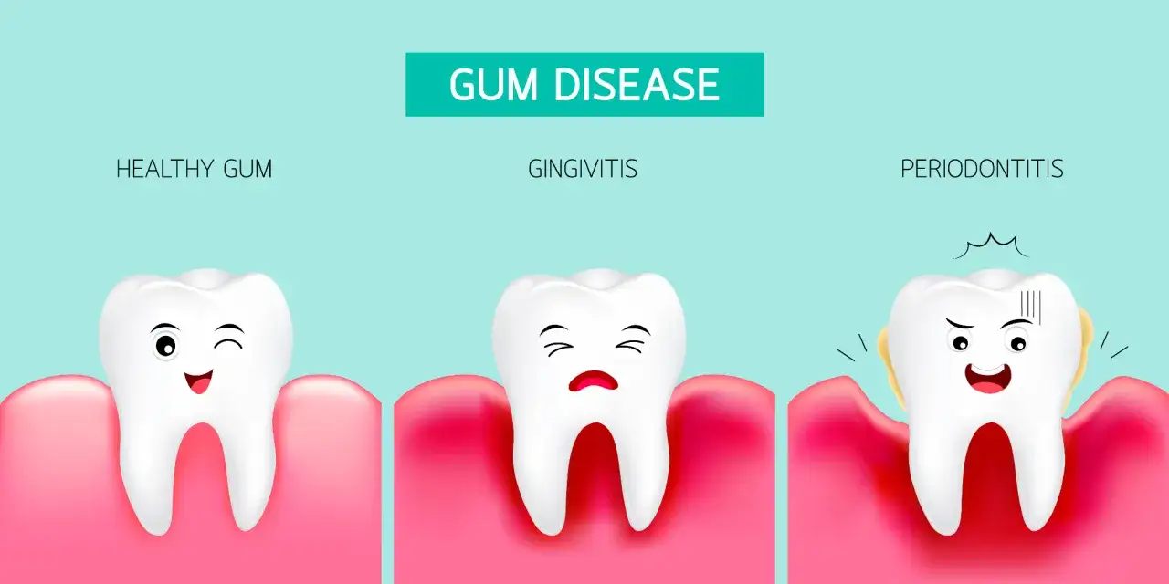 Ilustración de dientes sanos, gingivitis y periodontitis. La periodontitis muestra un diente con encías rojas e inflamadas, indicando la posible perdida de dientes.