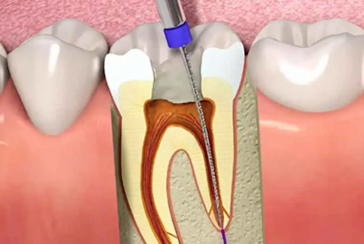 Procedimiento dental: un instrumento limpia el nervio de un diente, mostrando qué pasa si una caries llega al nervio.