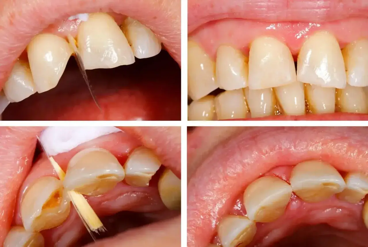 Primer plano de dientes, uno con un diente rajado y otro con una carilla dental rota.