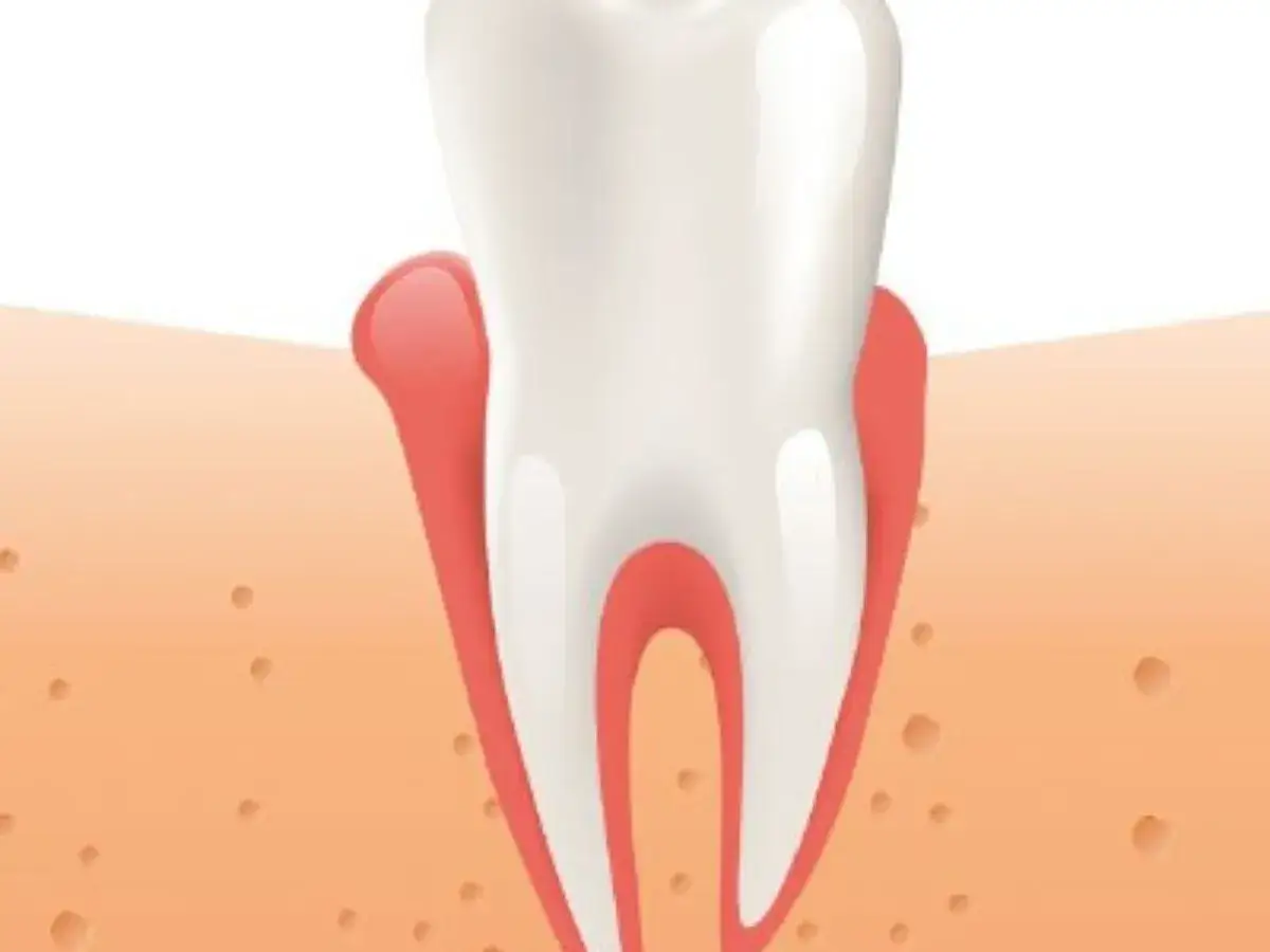 Diente con encías inflamadas, señal de la enfermedad de los dientes que se caen.