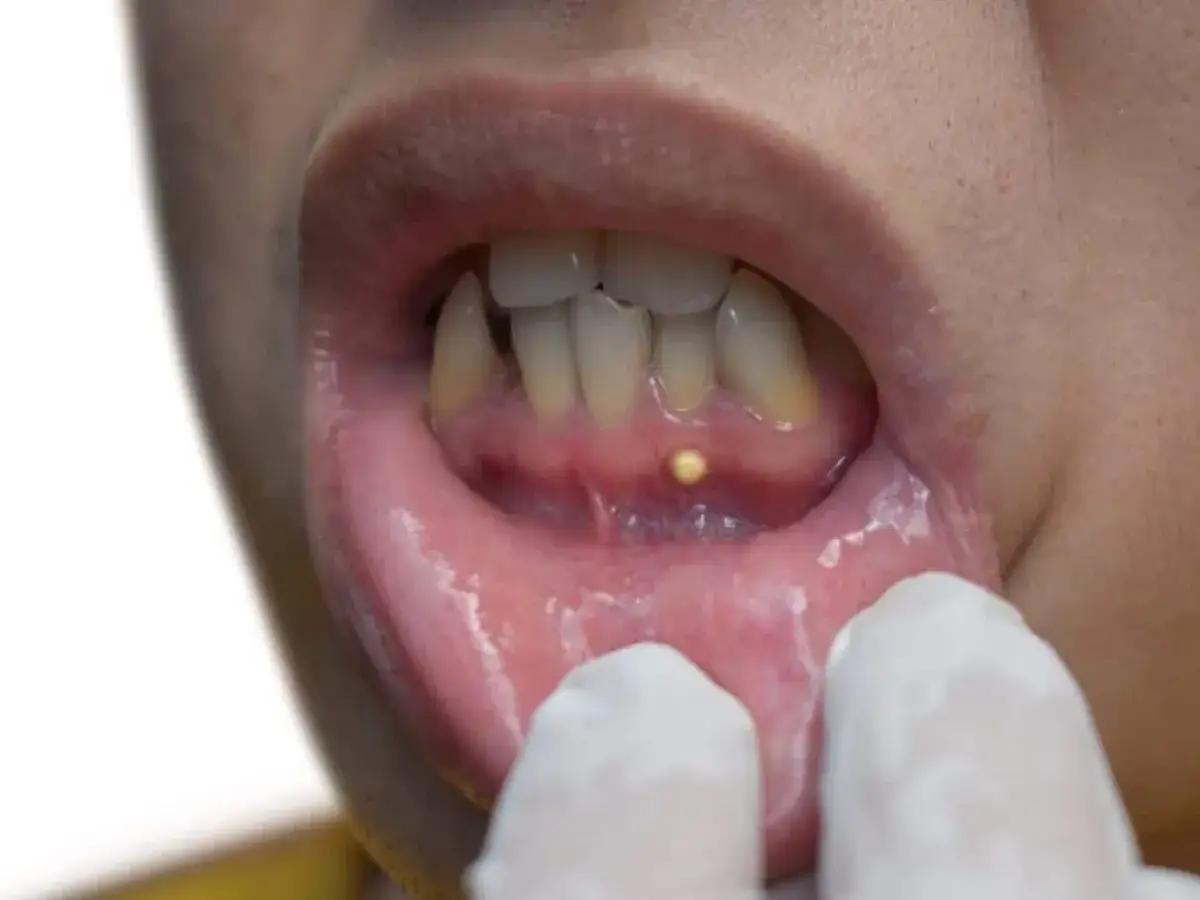 Pequeño flemón sin dolor en la encía, con un punto amarillo visible.