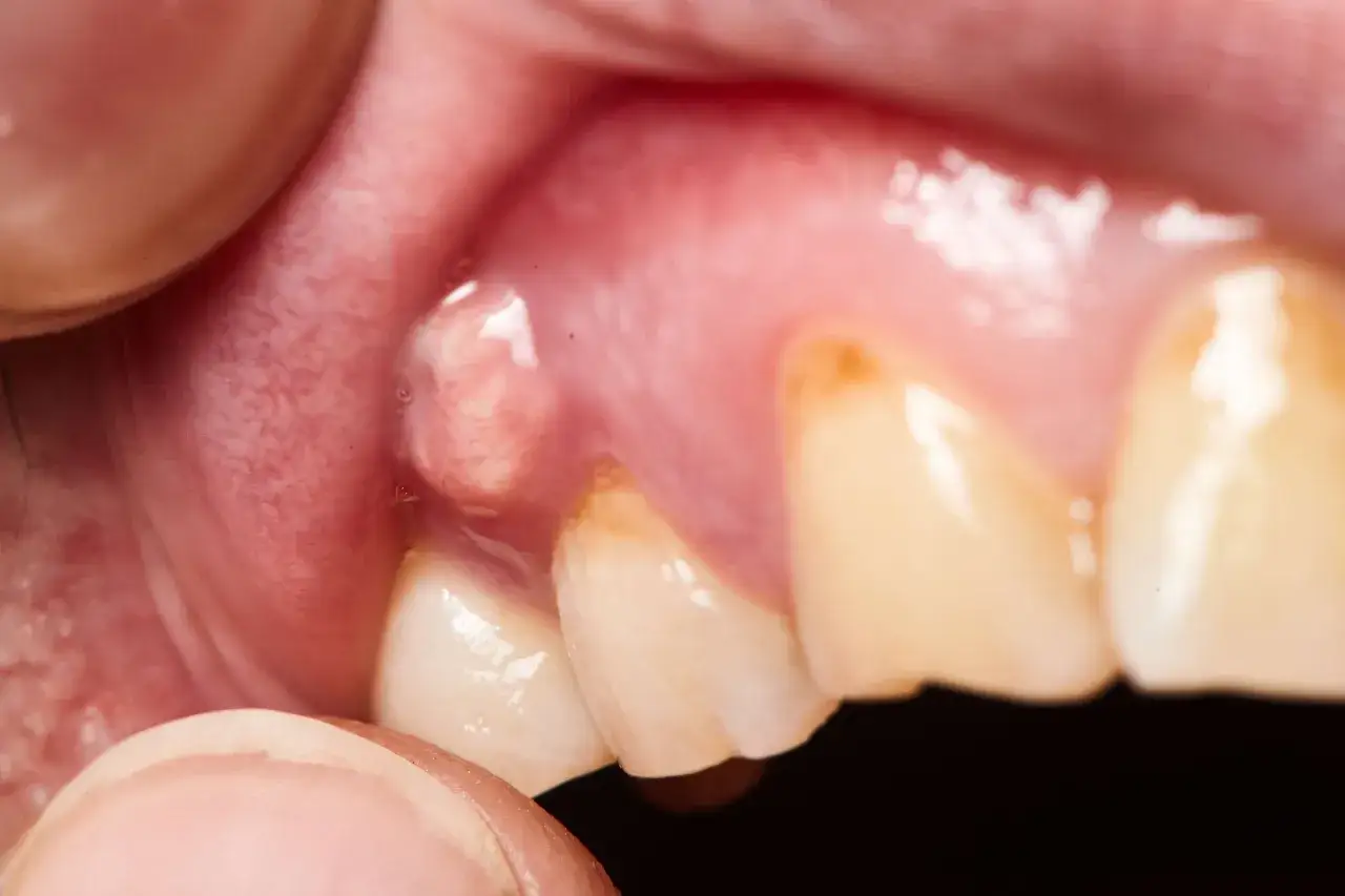 Un bulto blanco, posiblemente pus en la enc&iacute;a, cerca de dientes amarillentos.