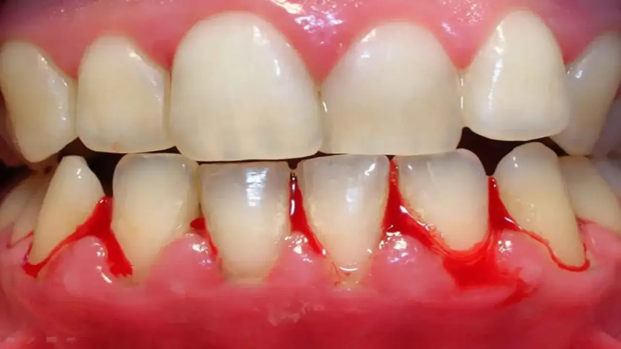 Encías inflamadas y enrojecidas con sangrado dental visible alrededor de los dientes inferiores.