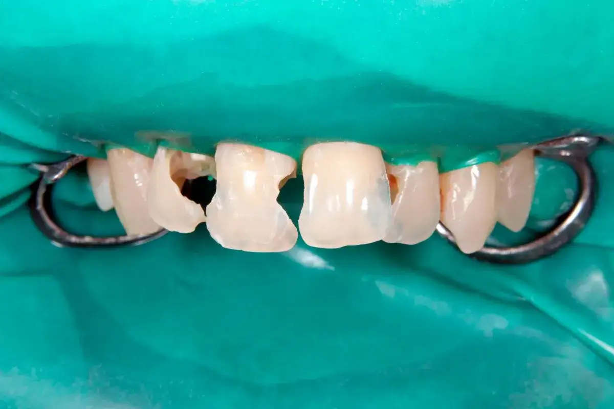 Dientes frontales con fisuras y caries, listos para el tratamiento. Se muestra el dique de goma y los clips para aislar la zona, preparándola para como arreglar una fisura en la muela.