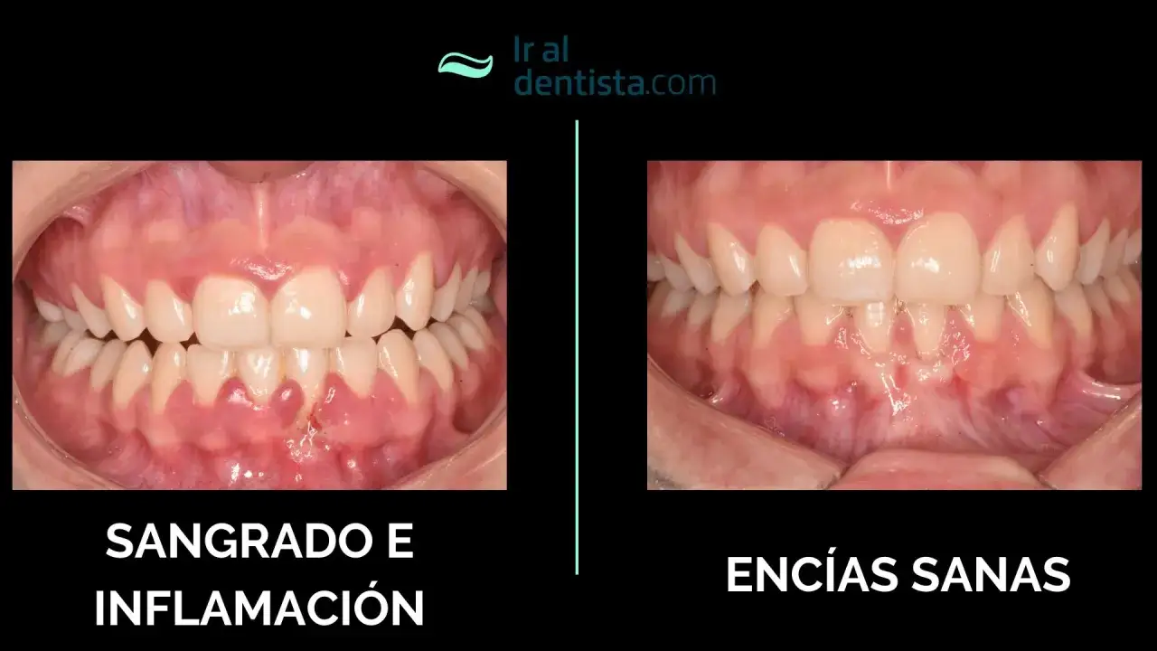 Comparaci&oacute;n de enc&iacute;as: antes con sangrado e inflamaci&oacute;n, despu&eacute;s de una limpieza profunda de enc&iacute;as, mostrando enc&iacute;as sanas.