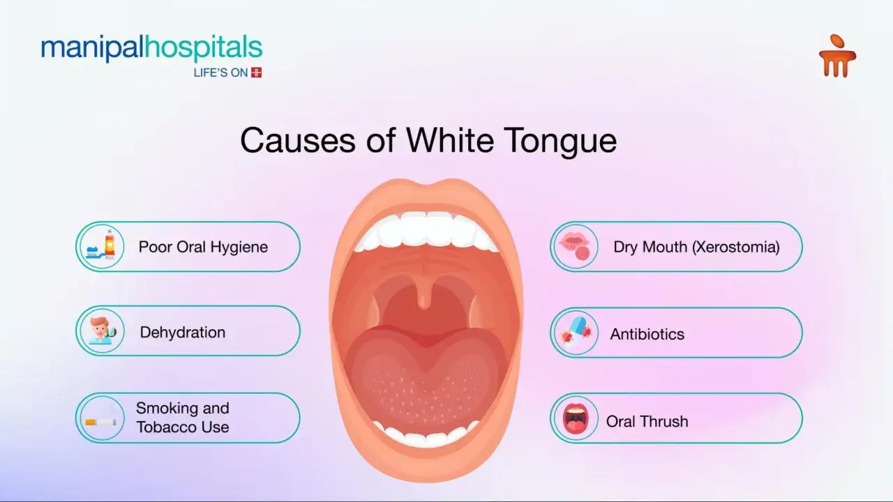 Ilustración de una boca abierta mostrando causas de placas en la lengua: mala higiene, deshidratación, tabaco, boca seca, antibióticos y candidiasis oral.