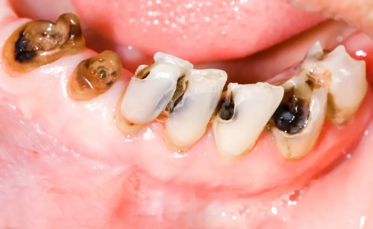 Dientes con caries avanzadas, mostrando una muela picada y otras con daños severos.