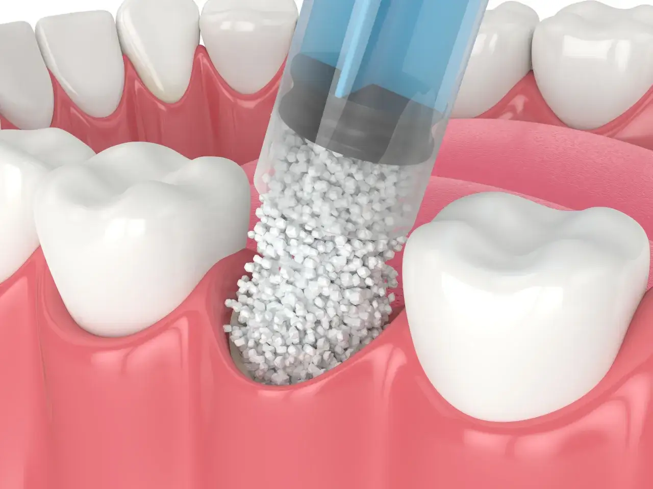 Jeringa aplica material para regenerar la pérdida de hueso dental.