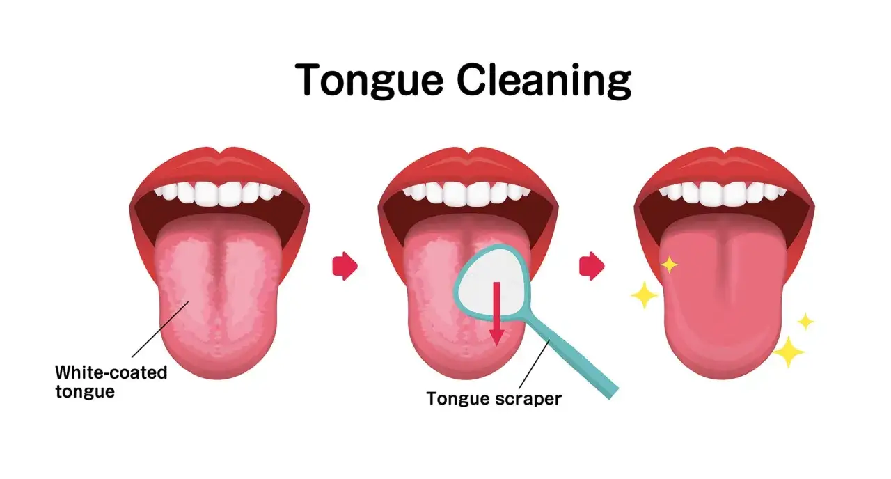 Ilustración muestra cómo limpiar la lengua: de una lengua blanca a una lengua limpia y brillante usando un raspador.