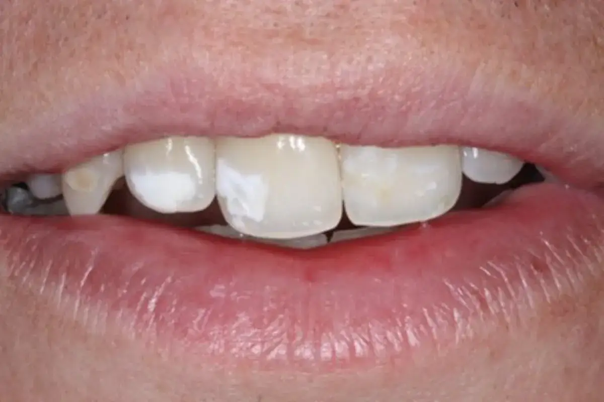 Primer plano de una boca mostrando dientes con manchas blancas, indicando posible desmineralización o fluorosis.