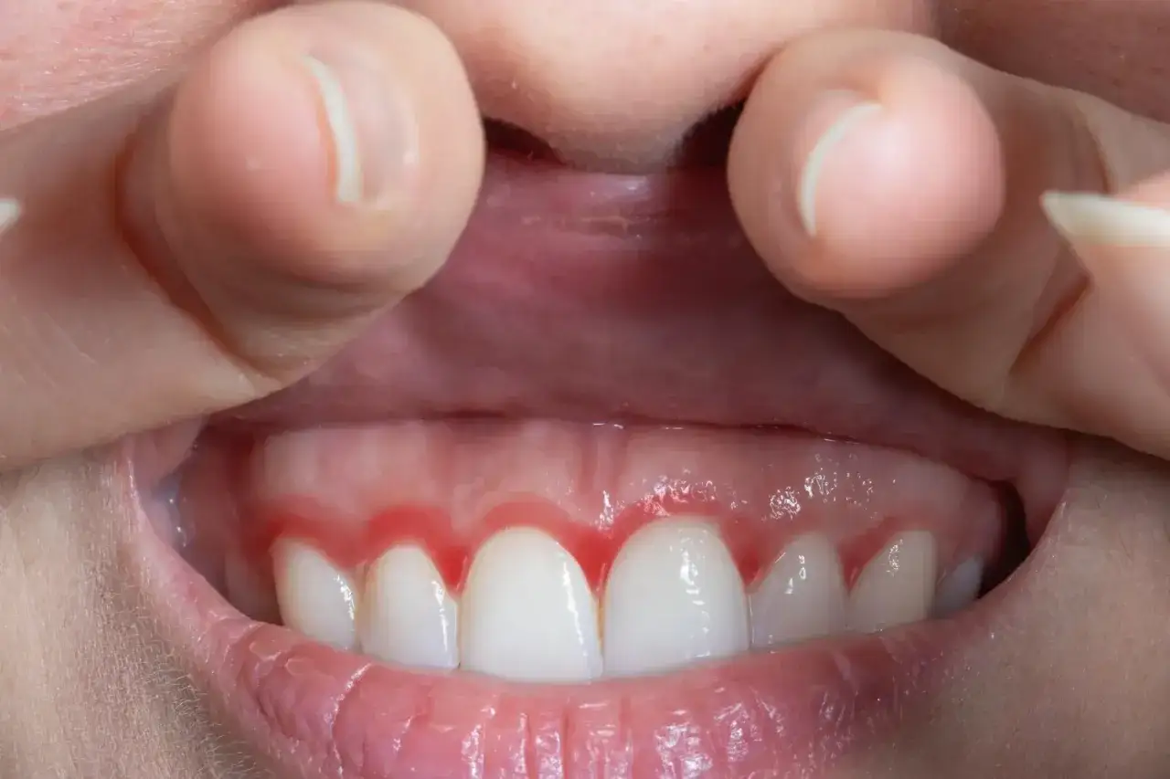 Encías inflamadas y enrojecidas, un signo de que el tabaco puede estar contribuyendo a la periodontitis.