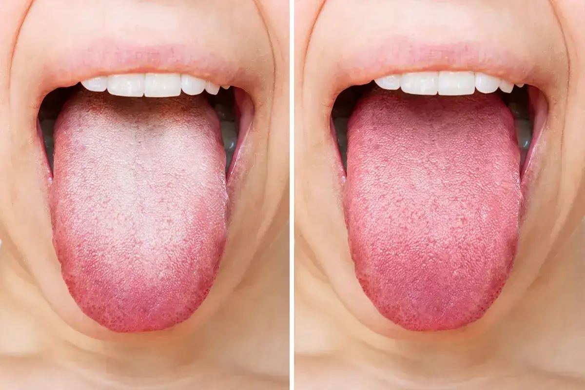 Comparación de lenguas: una muestra presenta lengua blanca, posiblemente por clorhexidina, la otra es rosada y saludable.