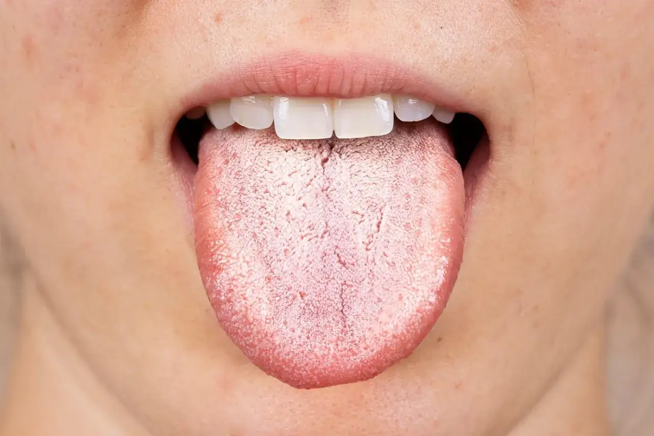 Lengua con capa blanquecina, indicativo de posible candidiasis oral. Se recomienda usar un enjuague antifungico.