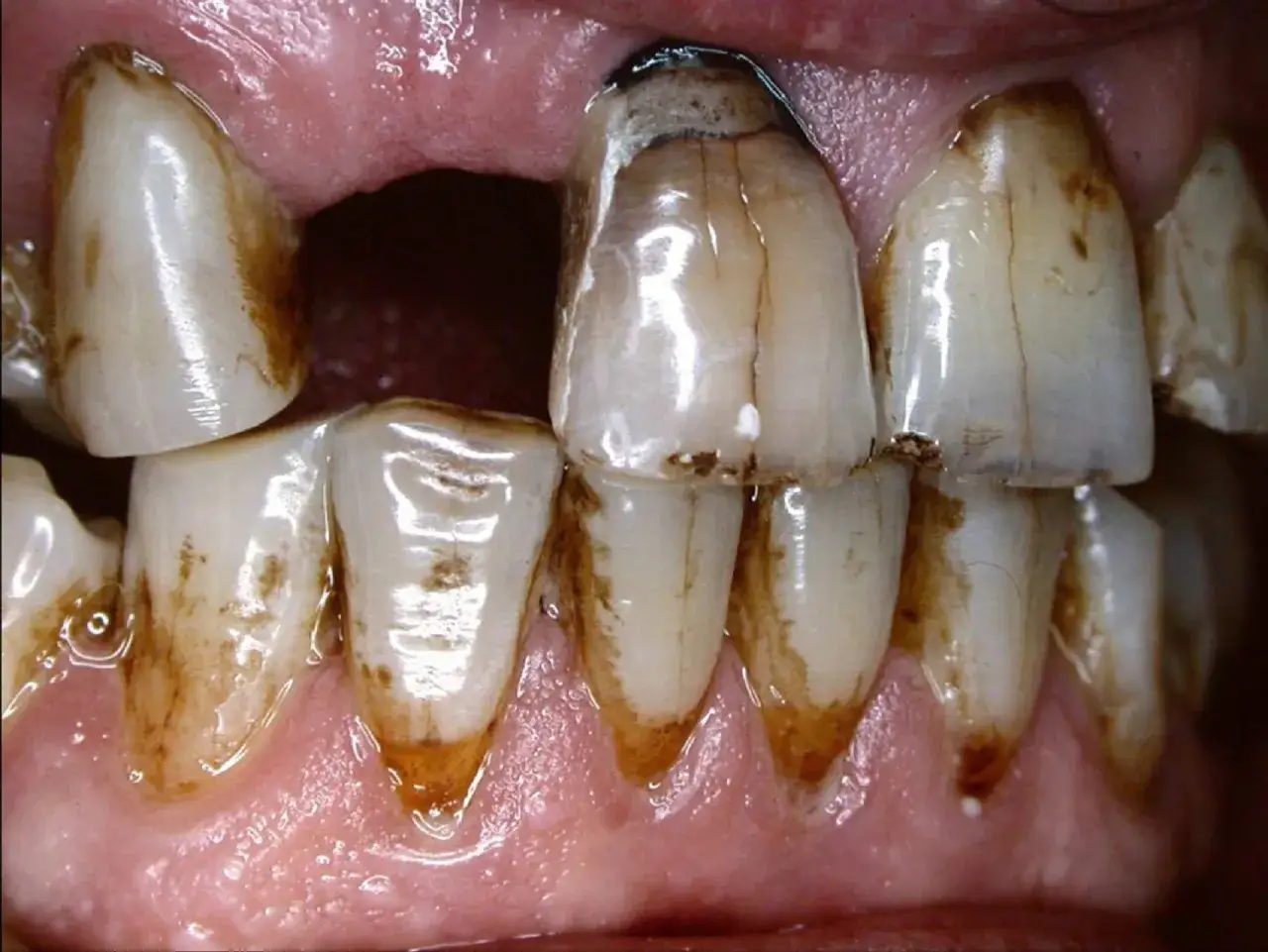 Dientes manchados y dañados, evidencia del efecto negativo del tabaco en nuestros dientes. Se observa sarro y posible caries.
