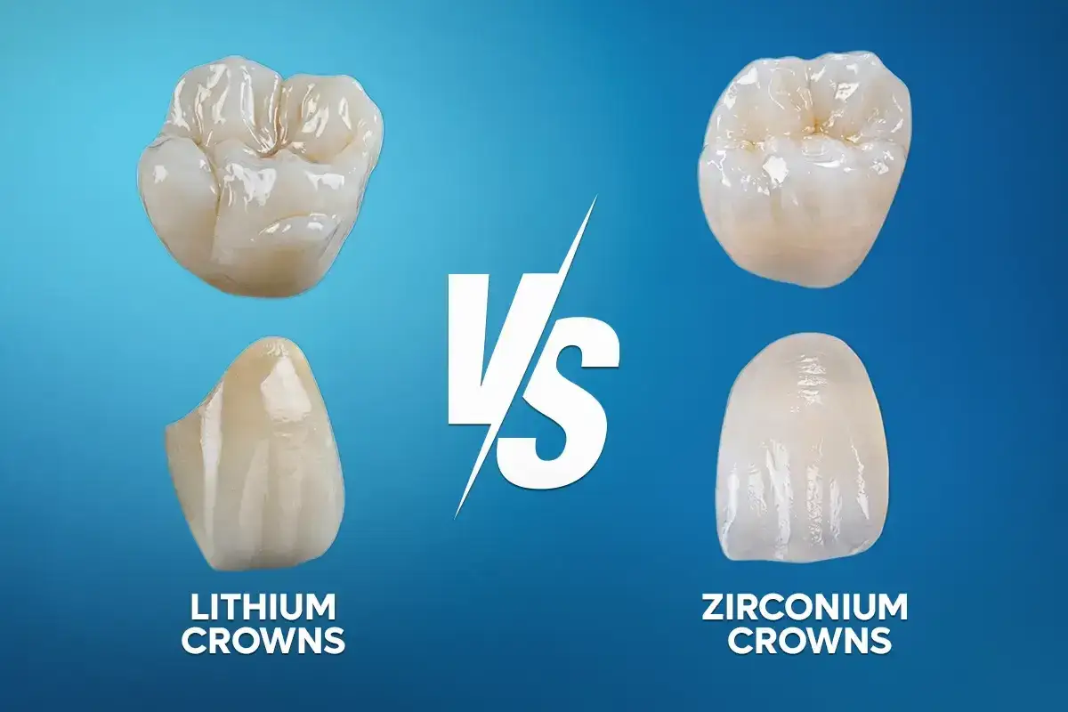 Comparación de coronas dentales: coronas de disilicato de litio vs. coronas de zirconio.