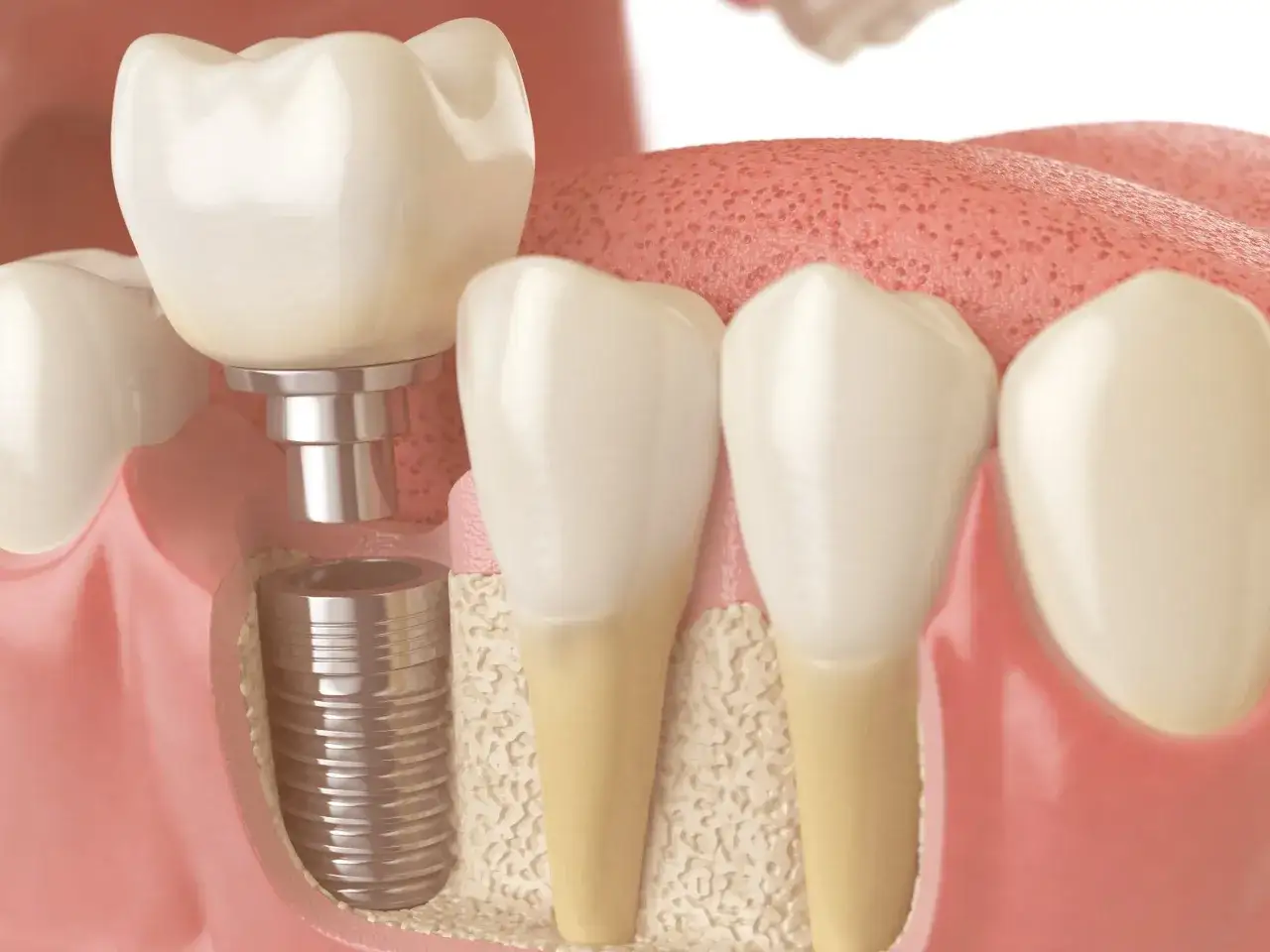 Implante dental en proceso de integraci&oacute;n con el hueso maxilofacial. Se observa el tornillo implantado y la corona dental lista para ser colocada.
