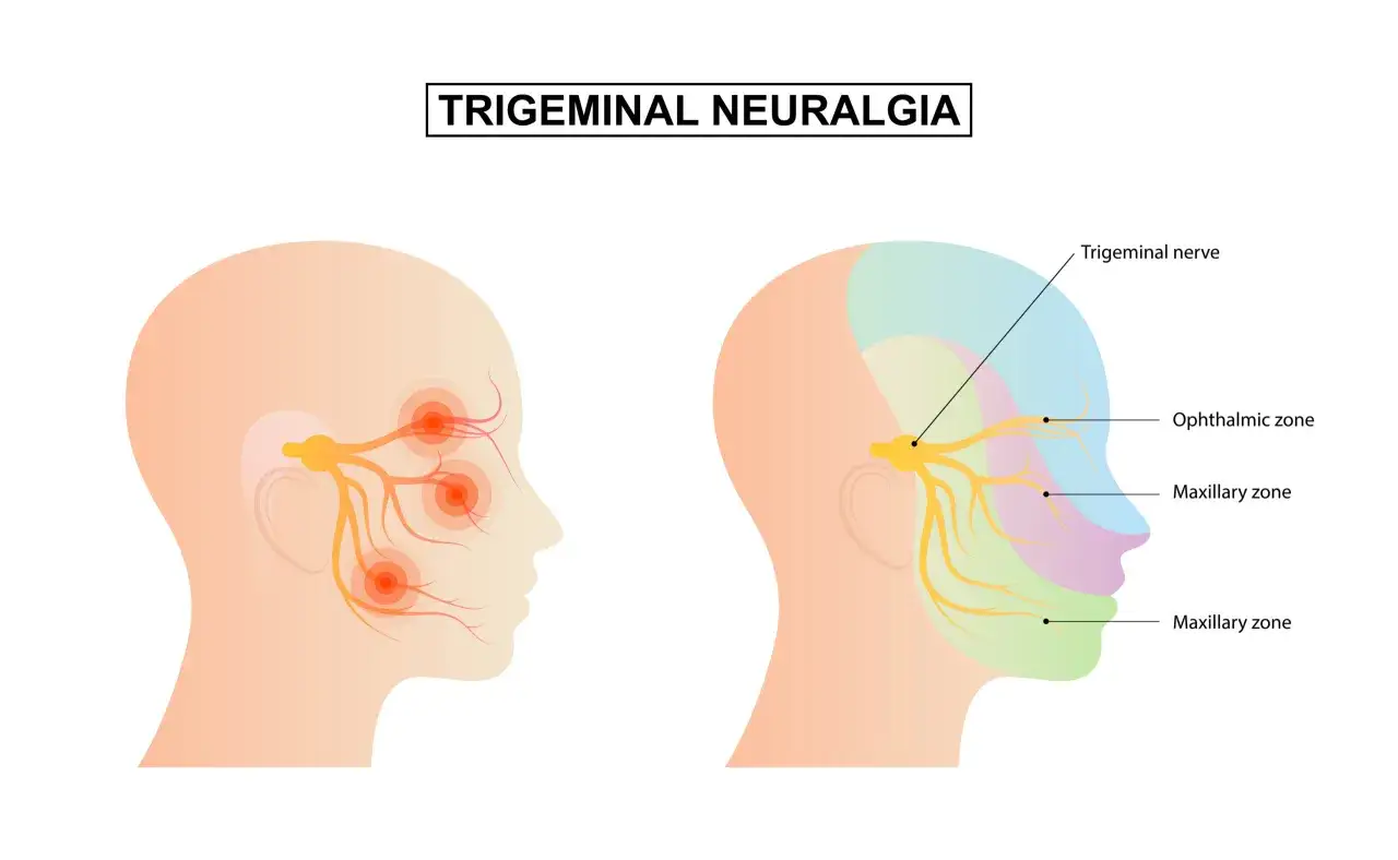 Ilustración de la neuralgia del trigémino, mostrando el nervio de la boca y sus zonas de afectación.