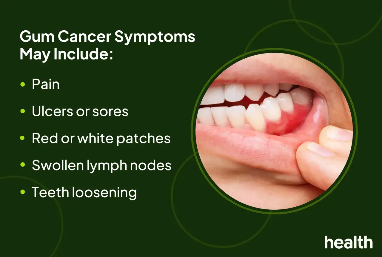 S&iacute;ntomas de c&aacute;ncer encias: dolor, llagas, parches rojos/blancos, ganglios inflamados, dientes flojos.