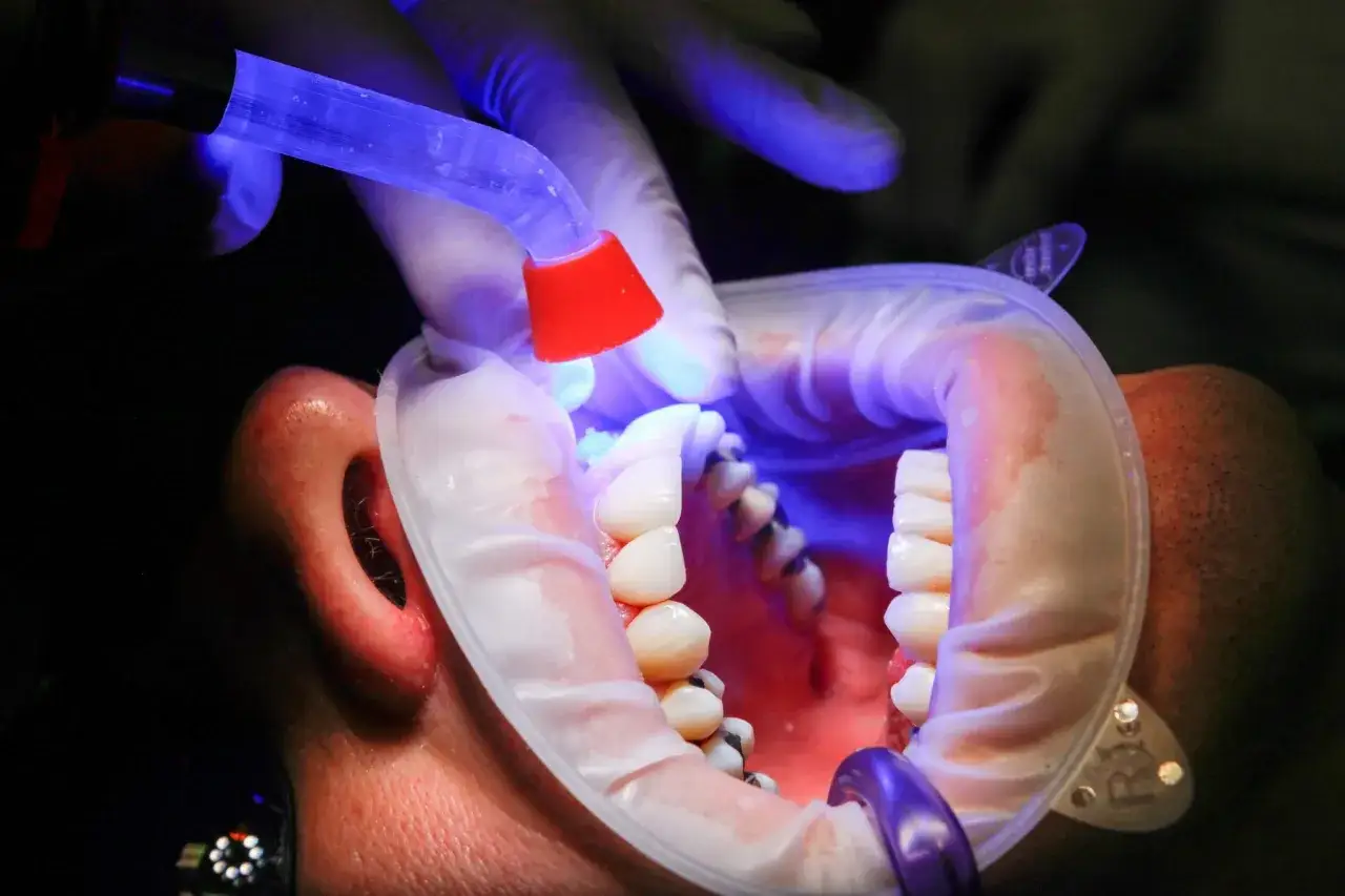 Dentista aplica luz azul para curar empaste en muela picada.