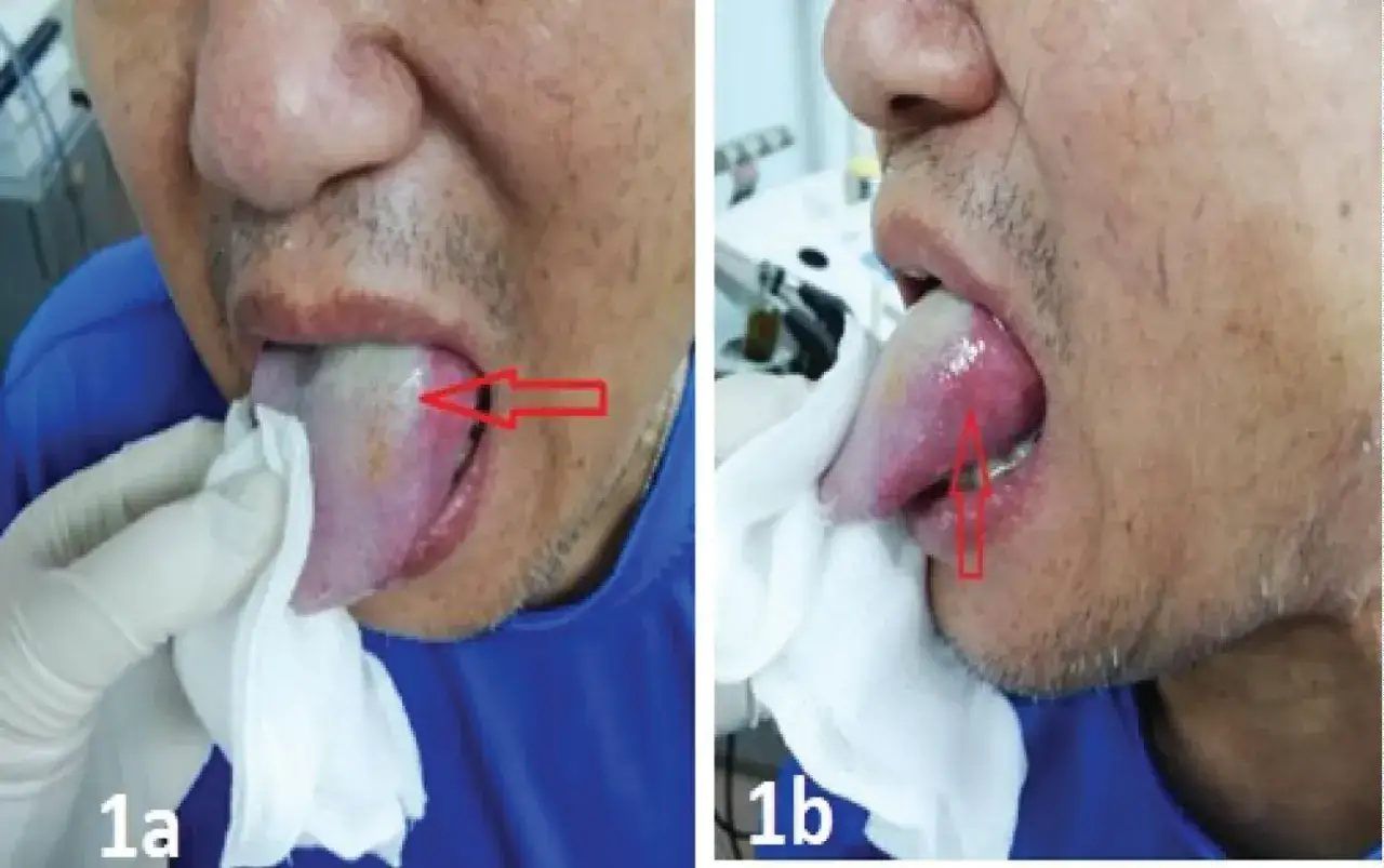 Imagen 1a: Lengua con exudado blanquecino, posible pus en la lengua. Imagen 1b: Lengua inflamada y enrojecida, con exudado.