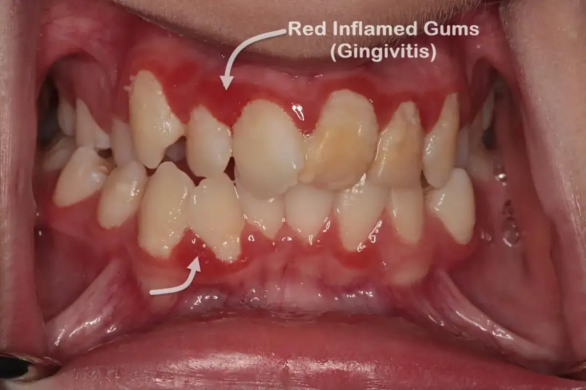 Encias muy inflamadas y rojas alrededor de los dientes, indicando gingivitis.