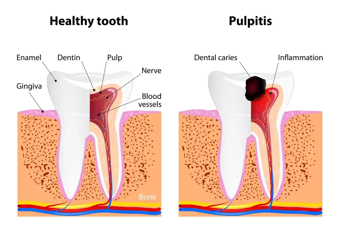 Comparaci&oacute;n de un diente sano con pulpitis. La caries dental expone el nervio de muela, causando inflamaci&oacute;n.