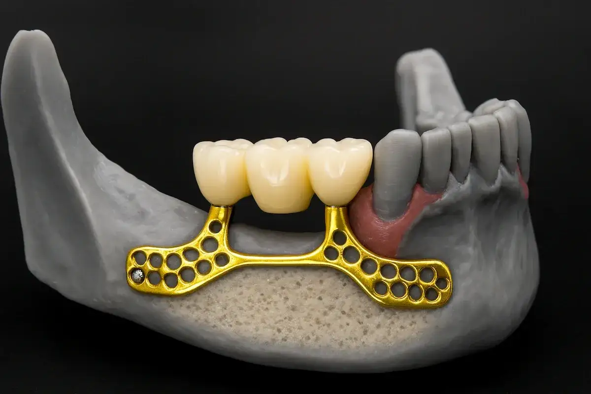 Modelo de mand&iacute;bula con puente dental dorado. Si no tengo hueso para implante dental, esta es una soluci&oacute;n.