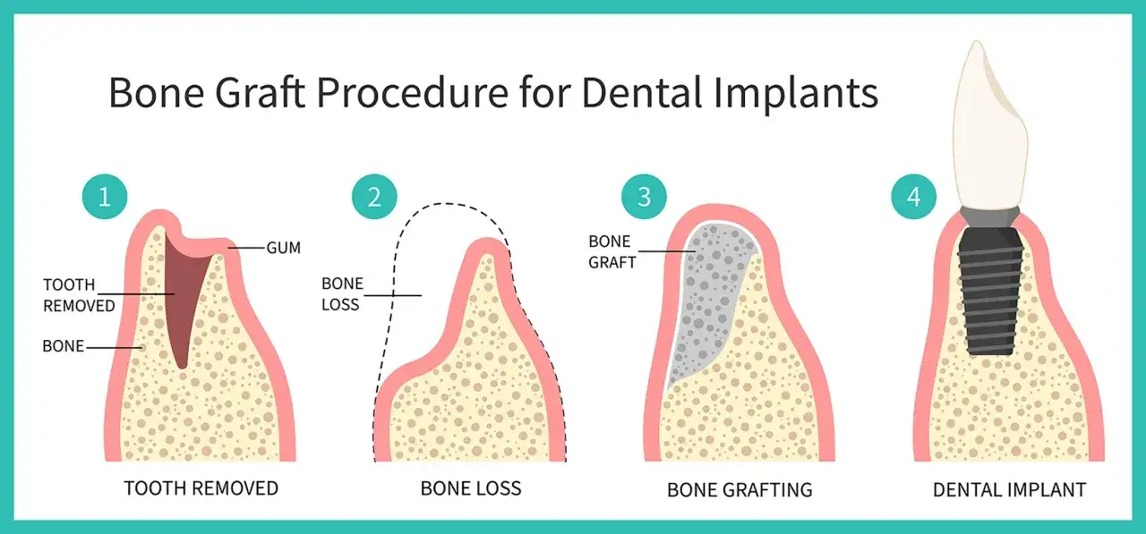 Ilustración muestra el proceso de injerto óseo para implantes dentales: extracción, pérdida ósea, poner hueso en la encía y colocación del implante.