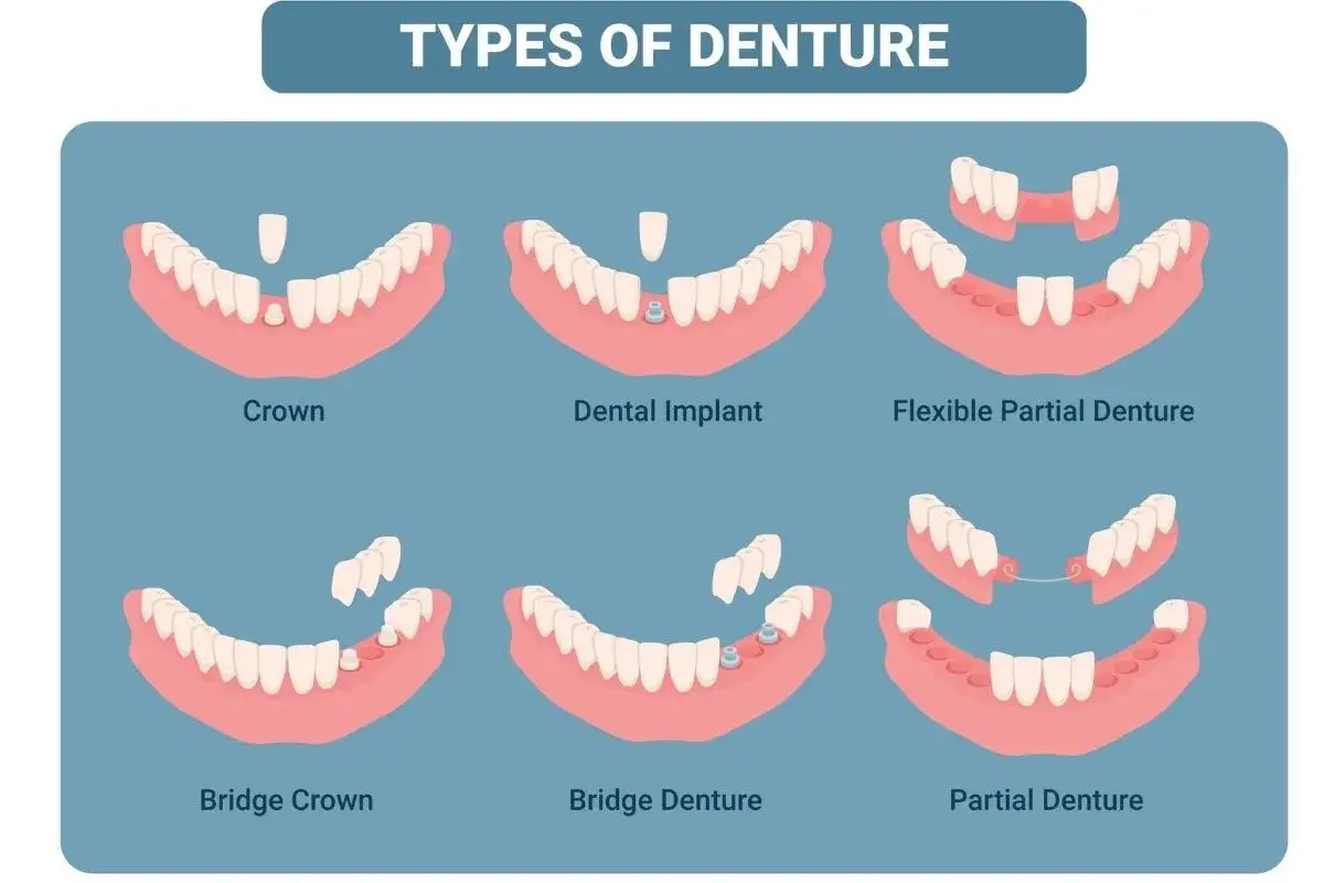 Ilustración muestra soluciones para la falta de dientes: coronas, implantes, puentes y dentaduras.
