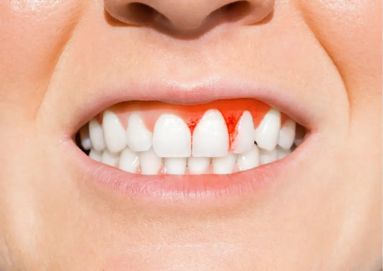 Encías sangrantes, un signo de que la gingivitis es contagiosa al besar.