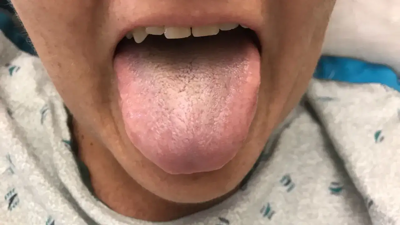 Lengua de fumador con aspecto blanquecino y rugoso, mostrando posibles signos de irritación o acumulación de residuos.