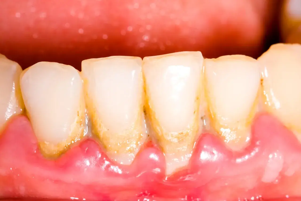 Dientes amarillentos y enc&iacute;as inflamadas, evidencia de dientes sin lavar y acumulaci&oacute;n de sarro.