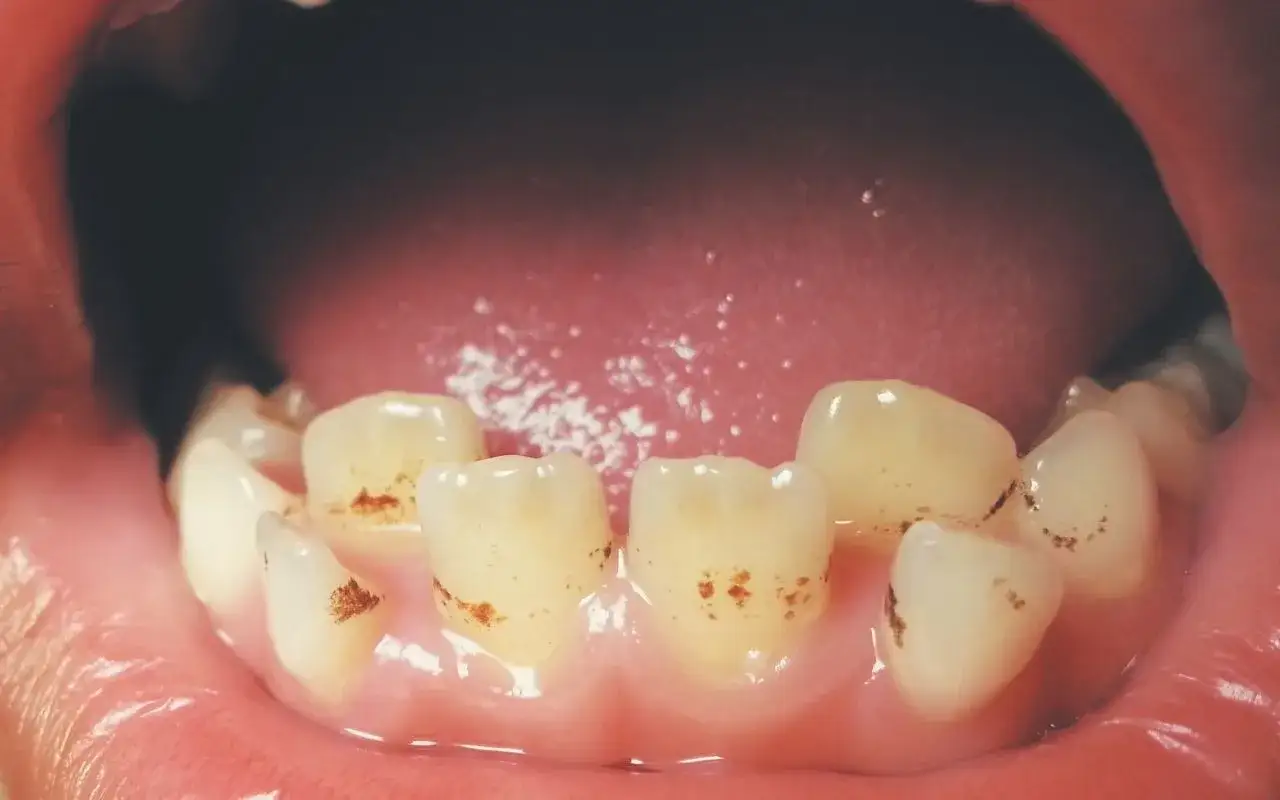 Dientes con manchas marrones y opacas, indicativo de fluorosis dental.