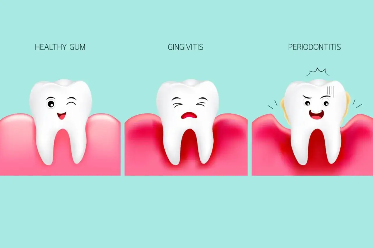 Dientes con encía picada: uno feliz y sano, otro con gingivitis y uno con periodontitis, mostrando la progresión de la enfermedad.