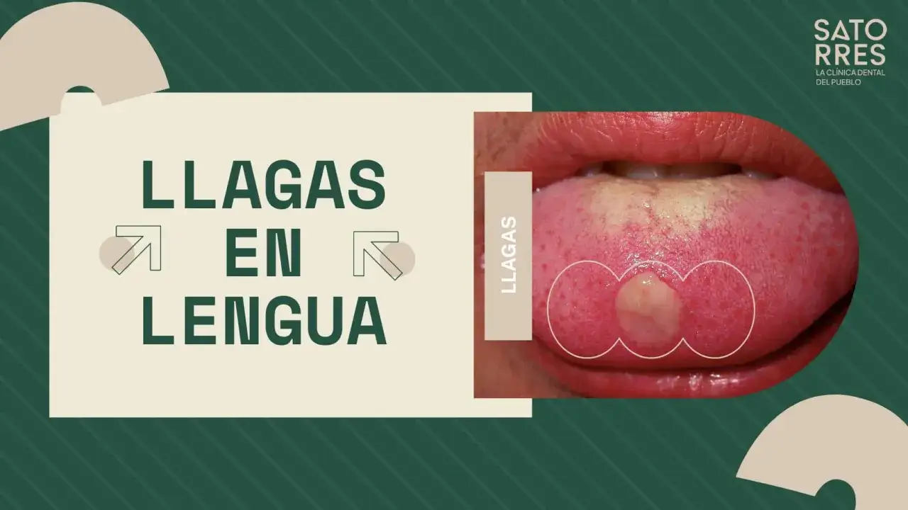 Primer plano de una llaga en la lengua que no se cura. Texto: