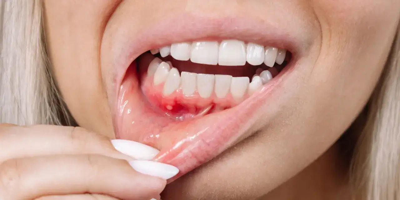 Boca abierta mostrando encías inflamadas y una llaga, indicando la necesidad de un curetaje periodontal.