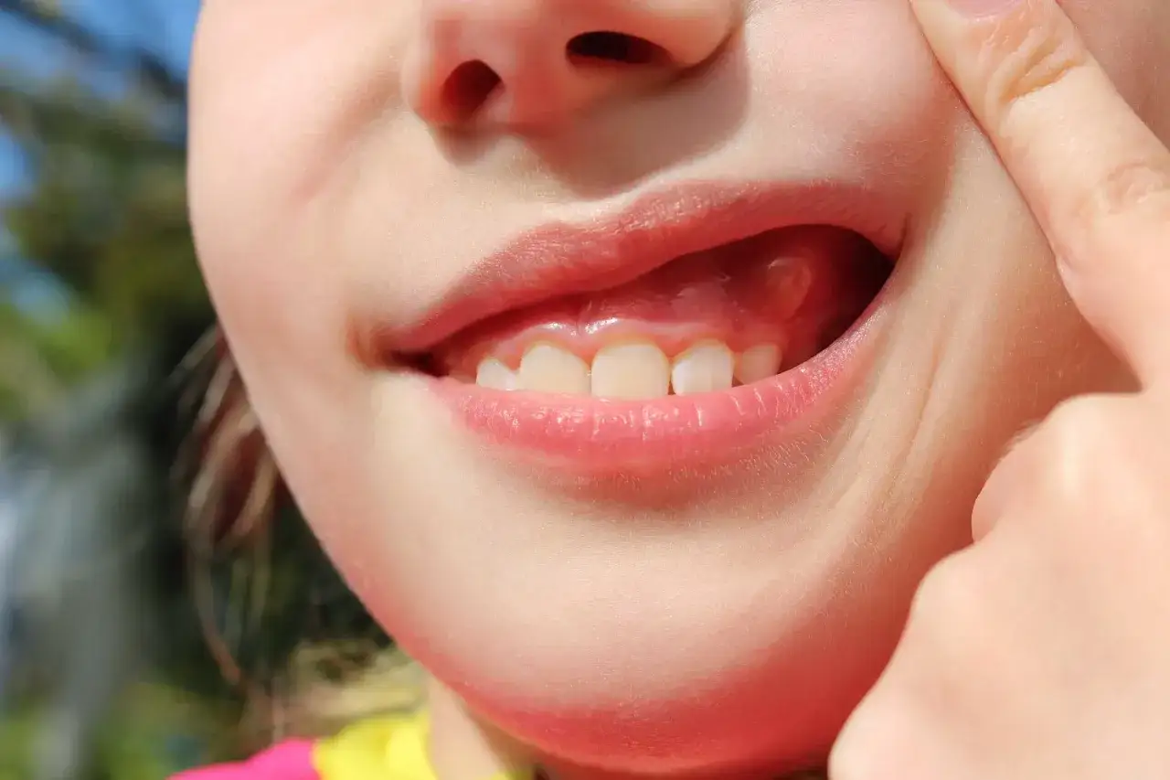 Niño muestra encías inflamadas, un síntoma común en el embarazo.