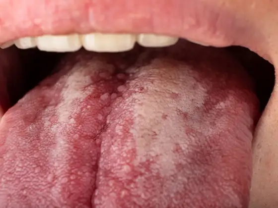 Llaga roja en la lengua - ¿Cuándo preocuparse y qué hacer?