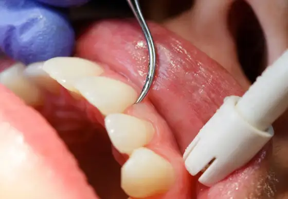 Gingivitis - Cómo tratar la inflamación de encías en casa y clínica