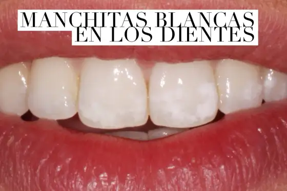 Manchas blancas en los dientes - Causas y tratamientos eficaces
