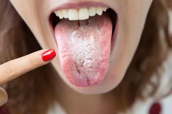 Llaga blanca en la lengua - ¿Qué es y cuándo preocuparse?