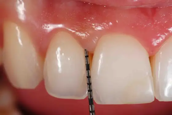 Gingivitis contagiosa al besar - ¿mito o realidad?