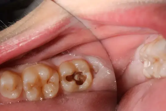 Muela con pulpa expuesta - ¿Qué hacer y cómo salvarla?