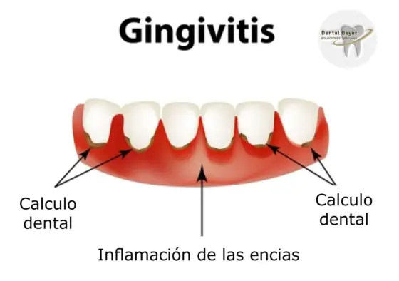 Encías muy inflamadas - Causas, soluciones y cuándo ir al dentista