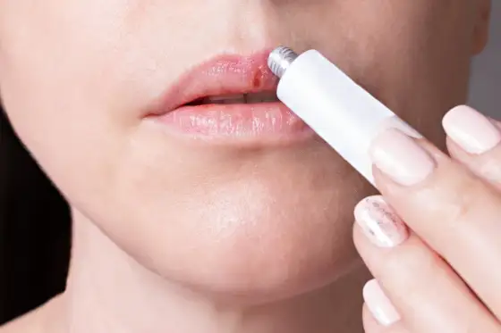 Herpes labial: ¿Es herpes o afta? Guía para identificarlo y tratarlo