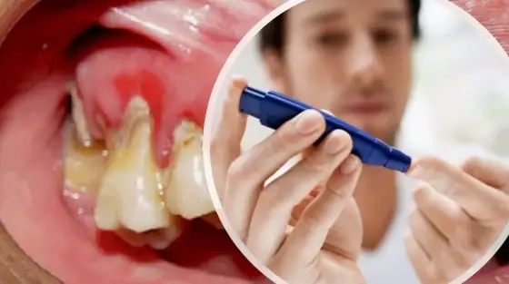 Diabetes y Caries - ¿Cómo proteger tu boca?