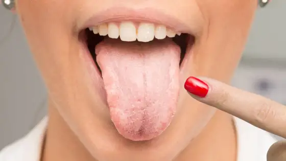 Candidiasis oral - Trata la infección y evita recaídas
