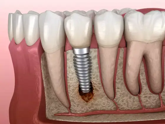 Bolsas inflamatorias en implantes - ¿Qué son y cómo tratarlas?